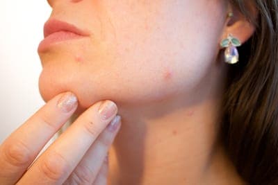Microchirurgie dermatologique — exérèse de lésions cutanées